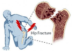 common sites of fractures due to falls.